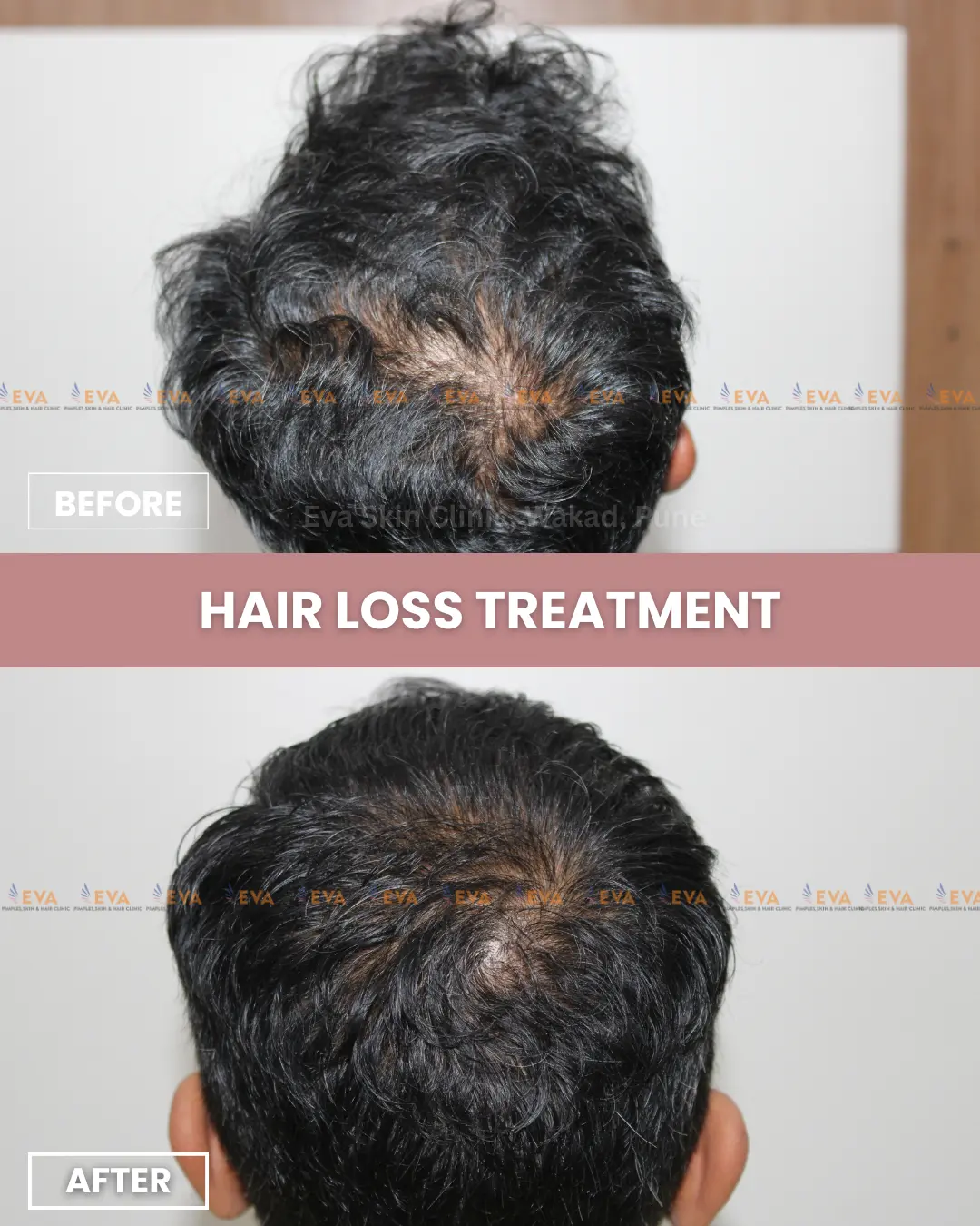 Hair-loss-treatment-results
