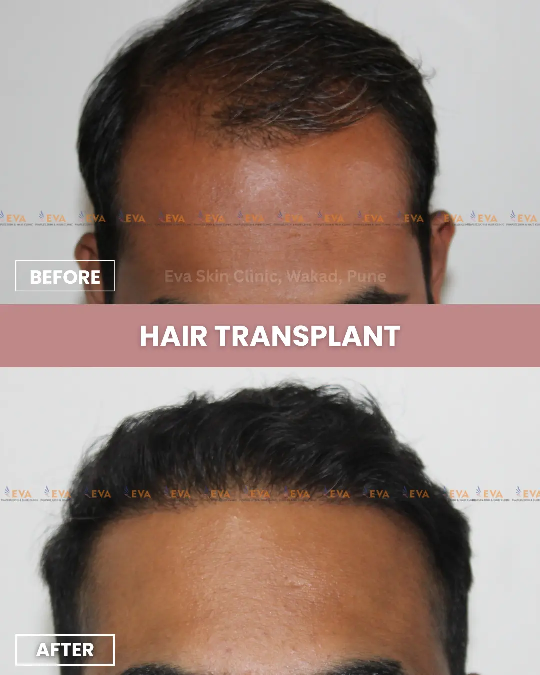 Hair-transplant before after best results
