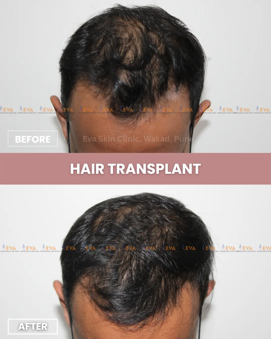 Hair transplant before after images