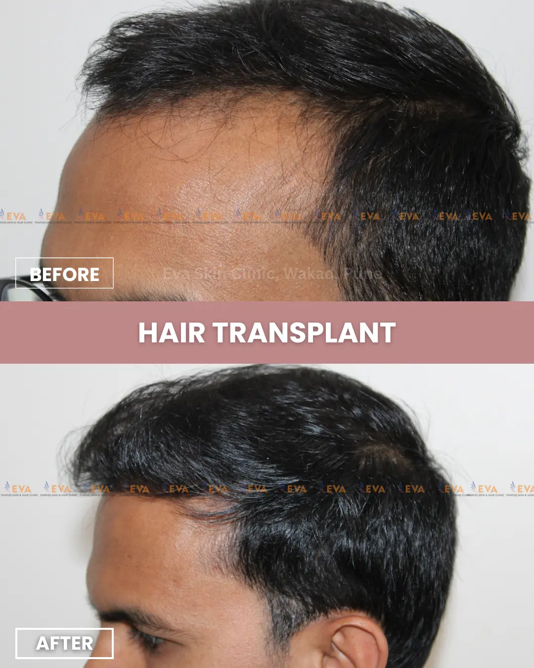Hair-transplant-before-after-pune