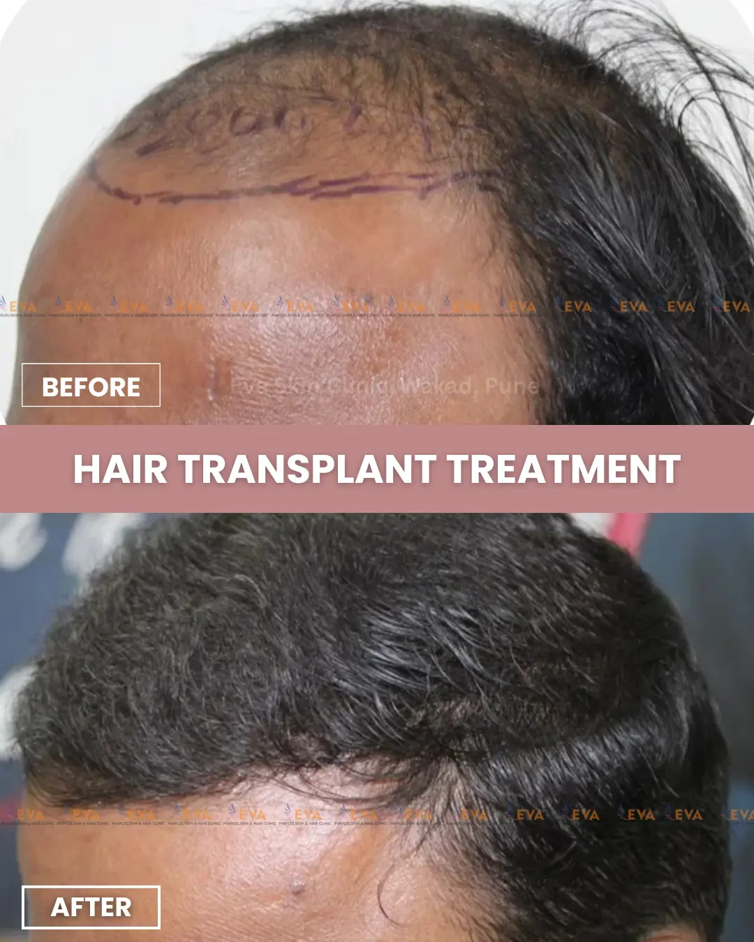 Hair-transplant-before-after-results-in-pune