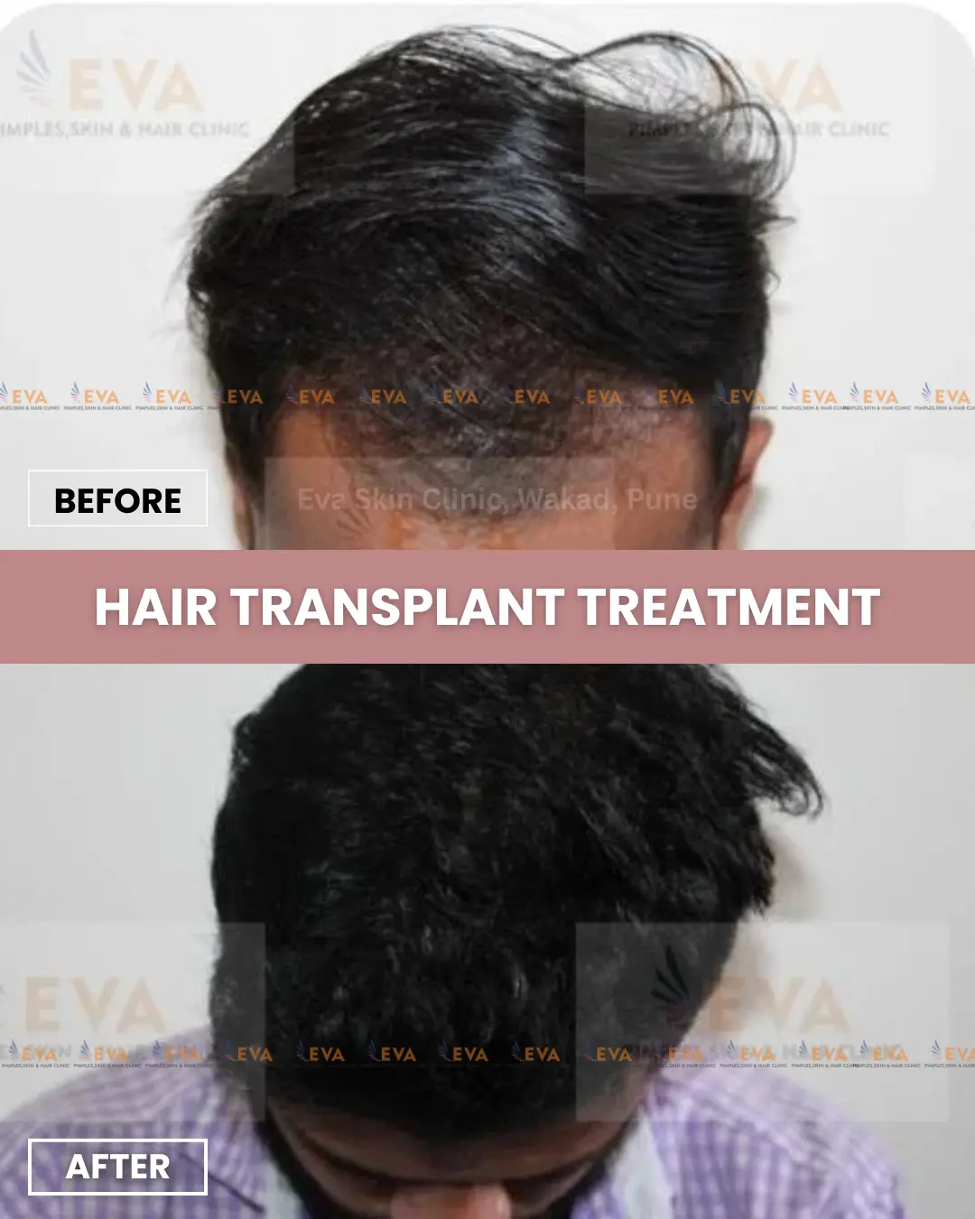 Hair-transplant-before-after-treatment