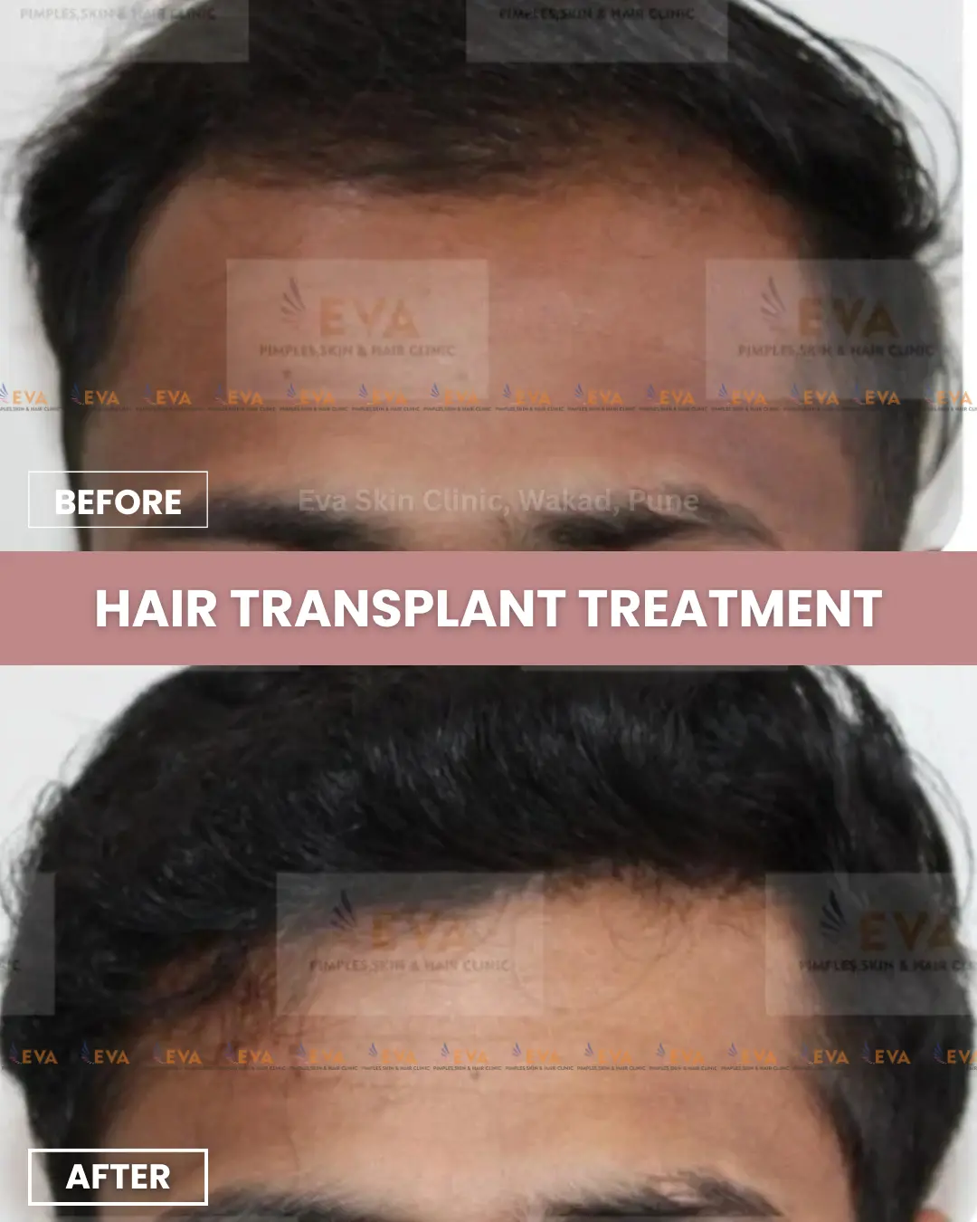 Hair-transplant-before-after