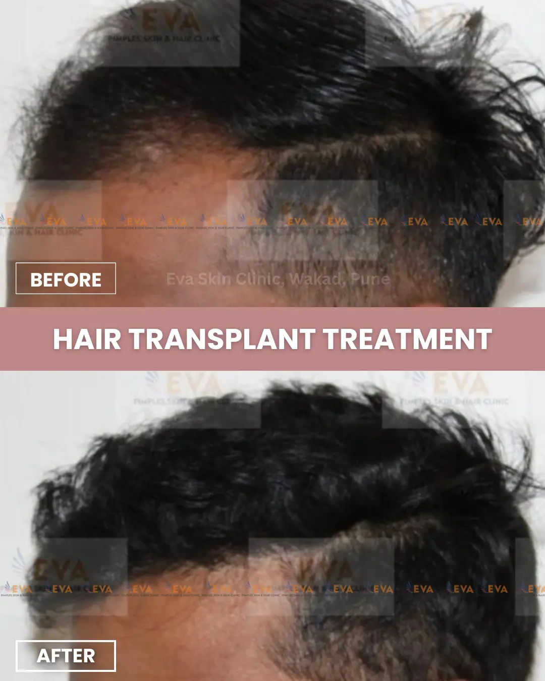 Hair-transplant-best-before-after