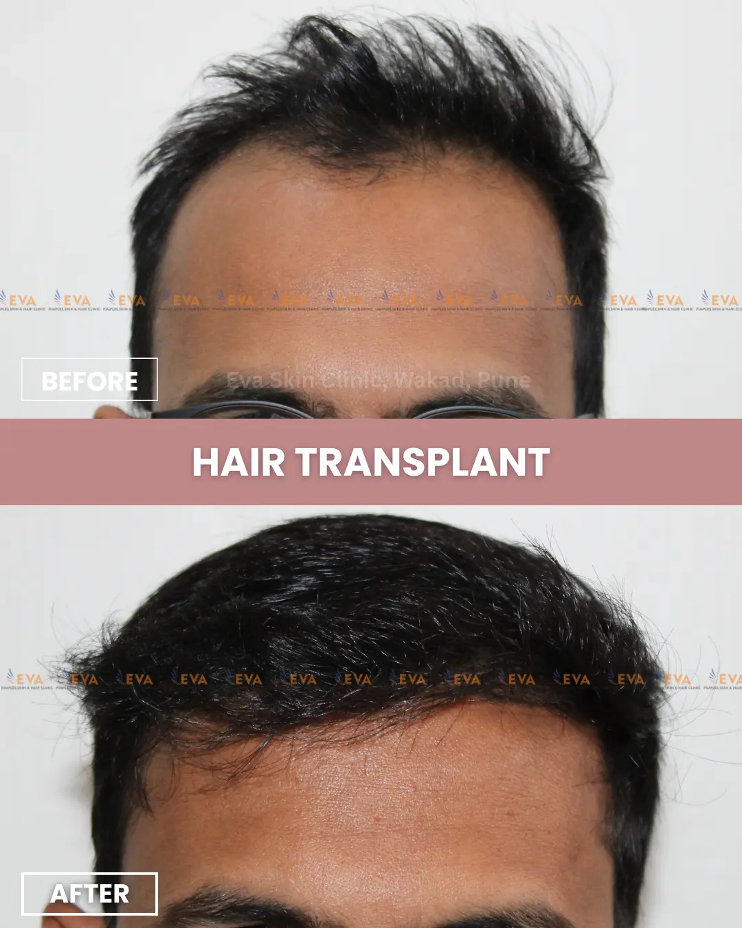 Hair transplant in pune