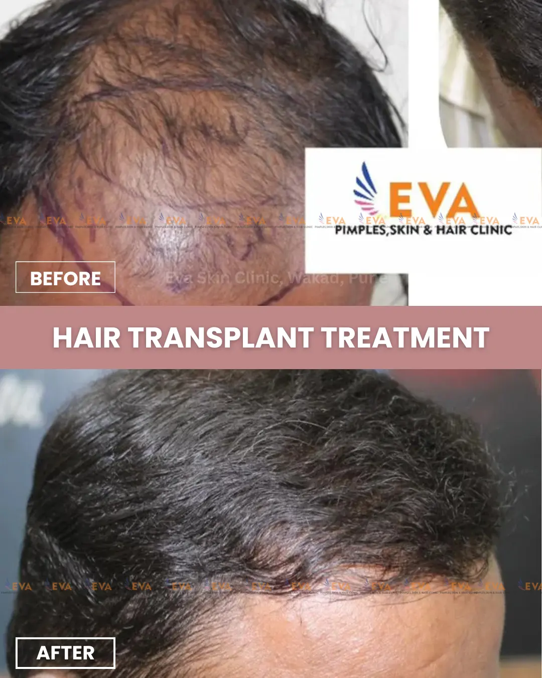 Hair-transplant-results-in-puner