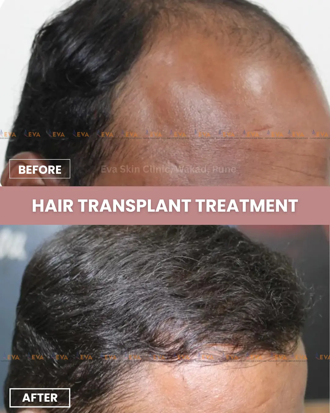 Hair-transplant-results
