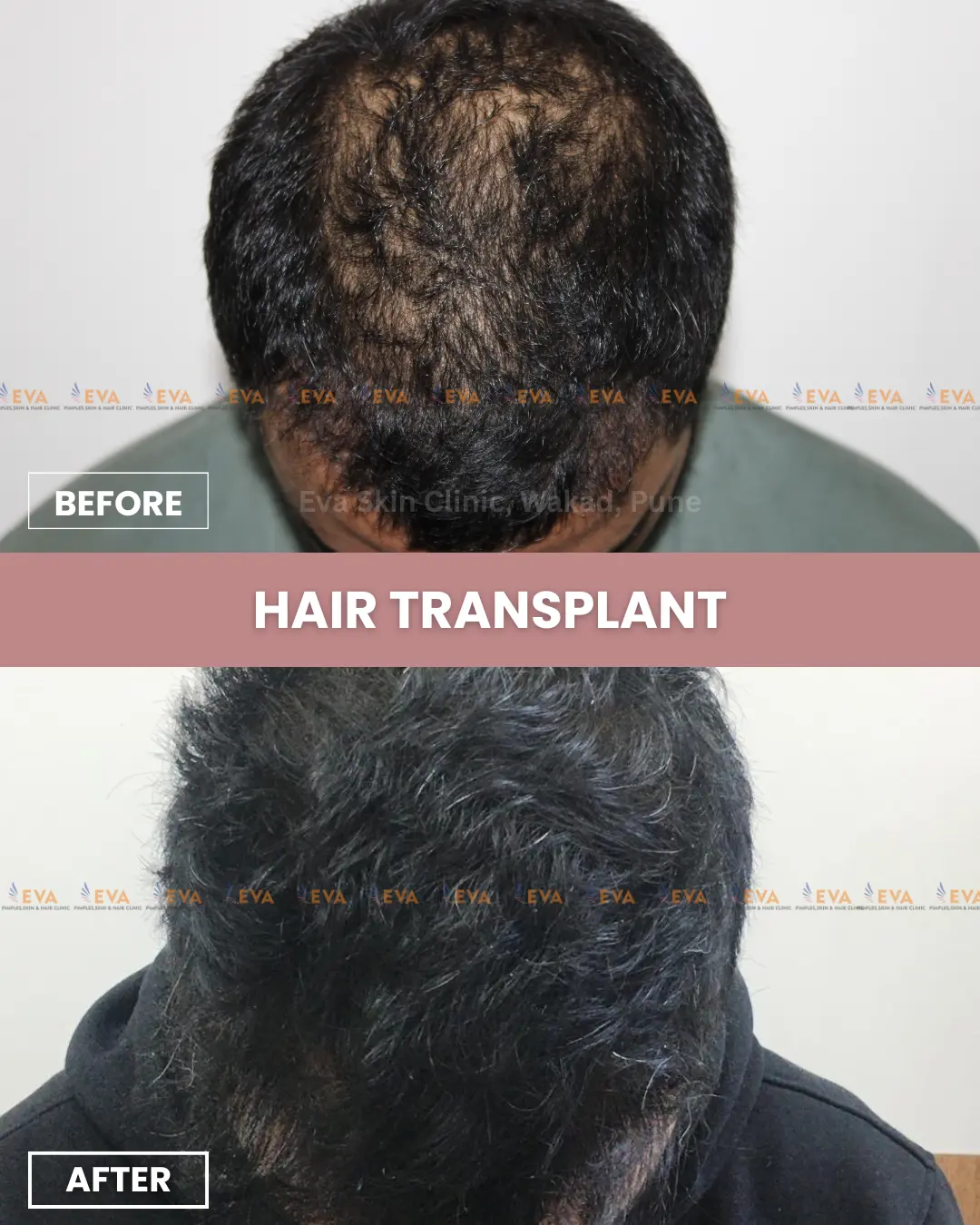 Hair-transplant-treatment-pune