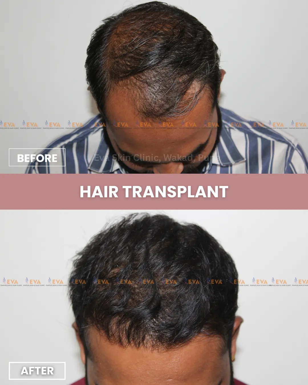 Hair-transplant