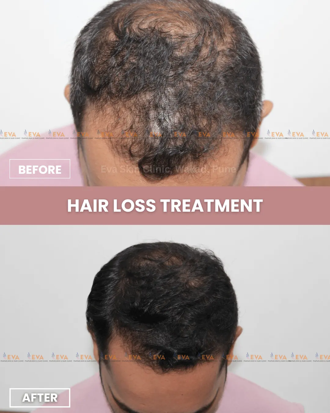 Hair-treatment