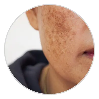 Hyperpigmentation