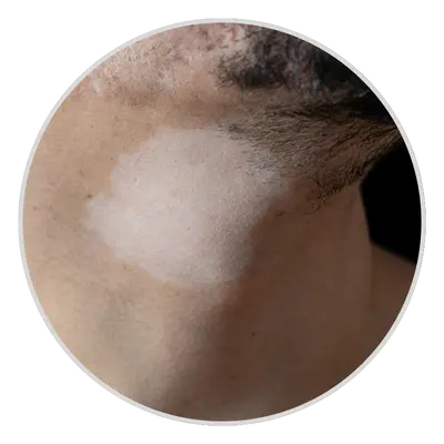 Hypopigmentation treatment in pune