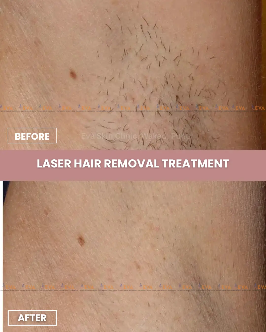 Laser-hair-removal-best-results