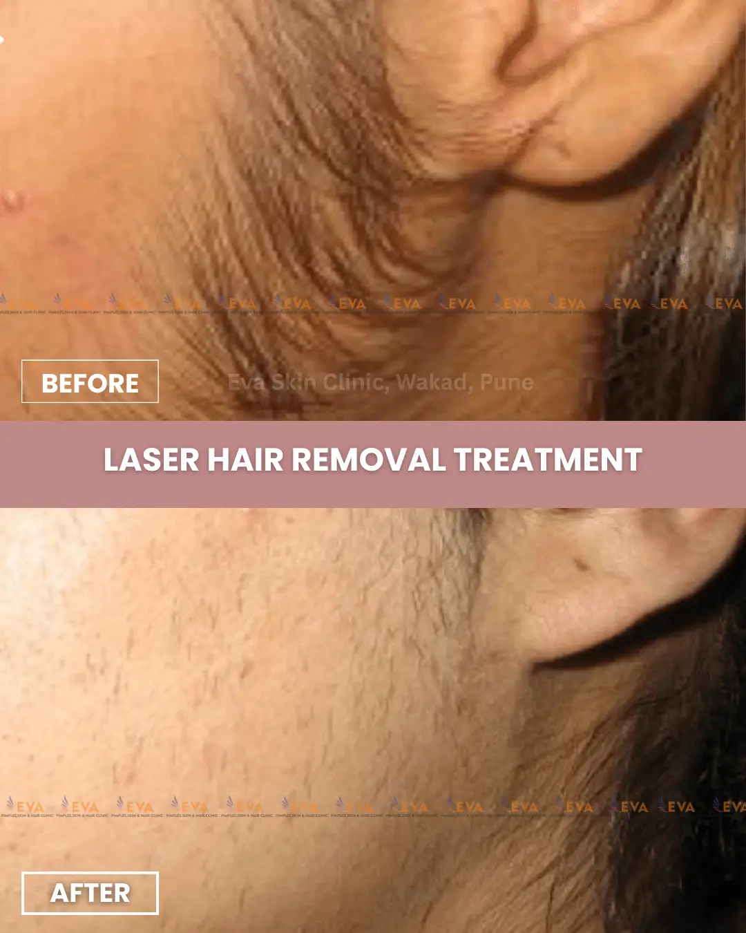 Laser-hair-removal-results-in-pune