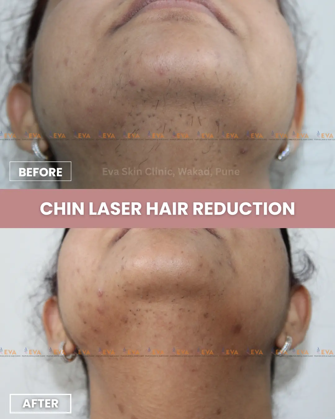 Laser-hair-removal-results