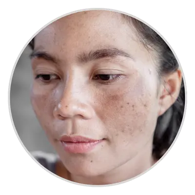 Melasma treatment in pune