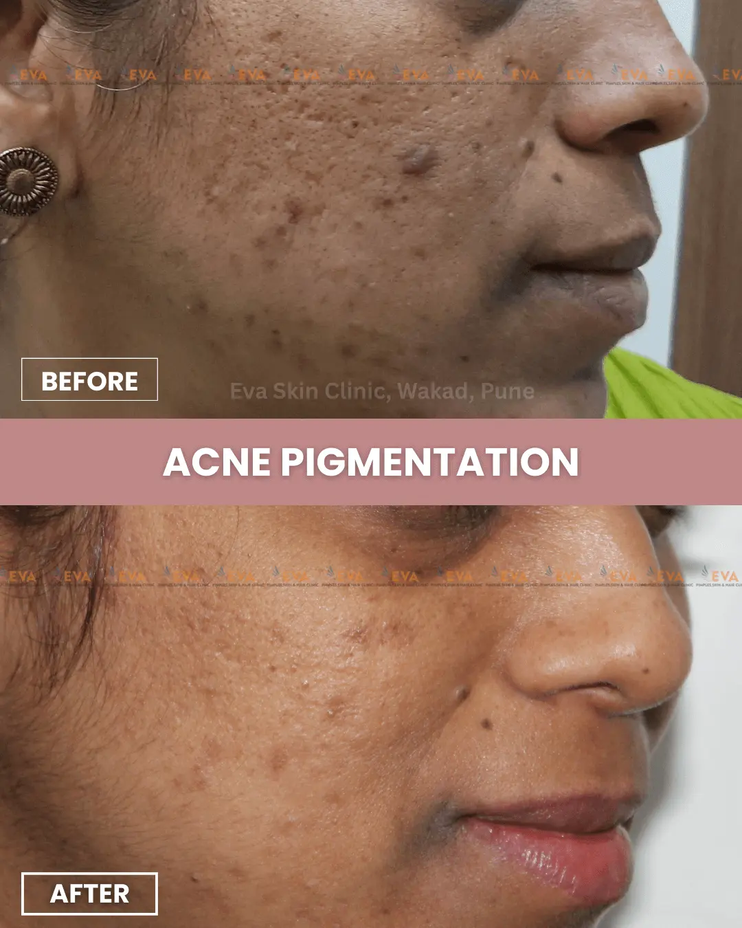 Pimple-results