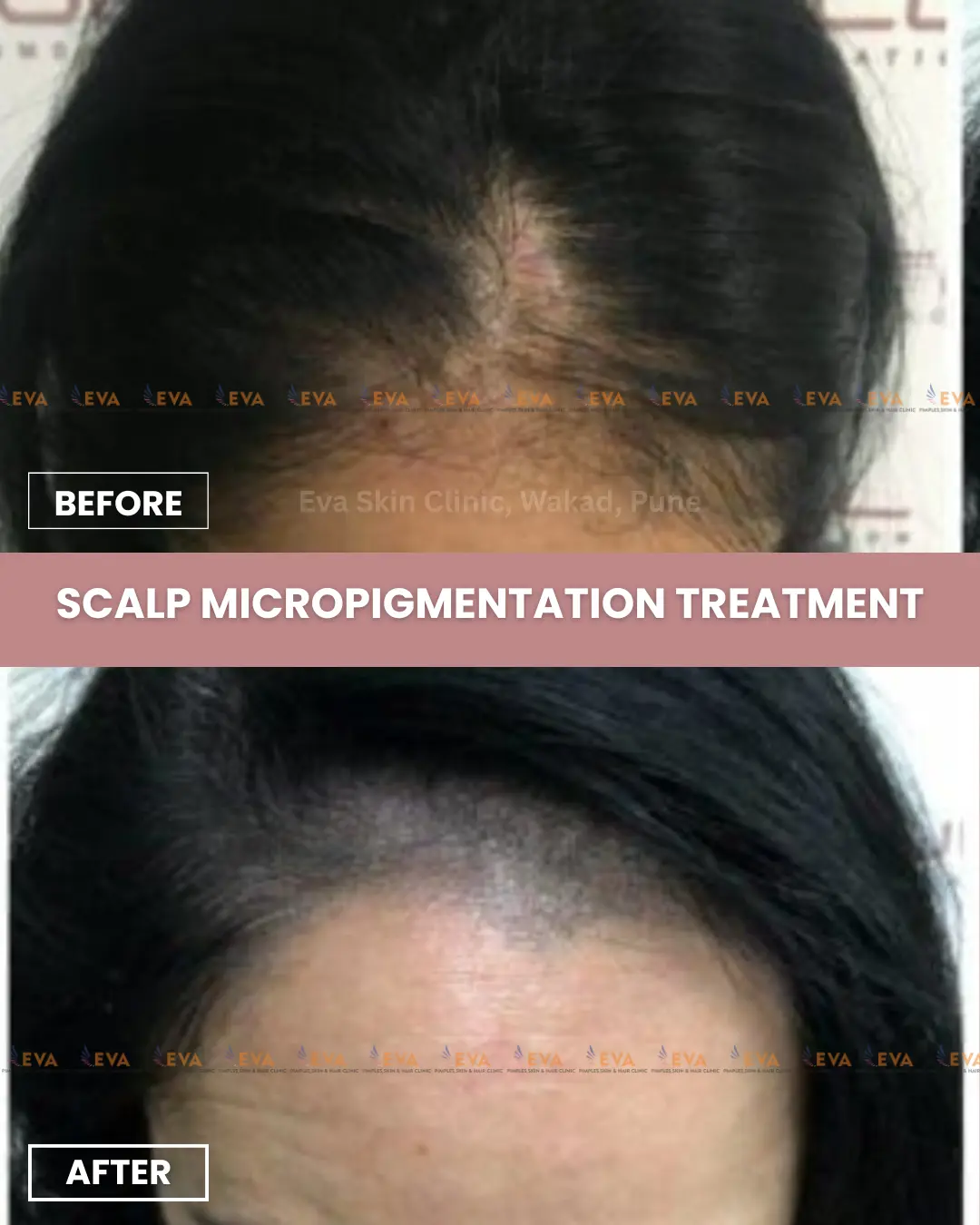Scalp-micropigmentation-before-after-results-in-pune