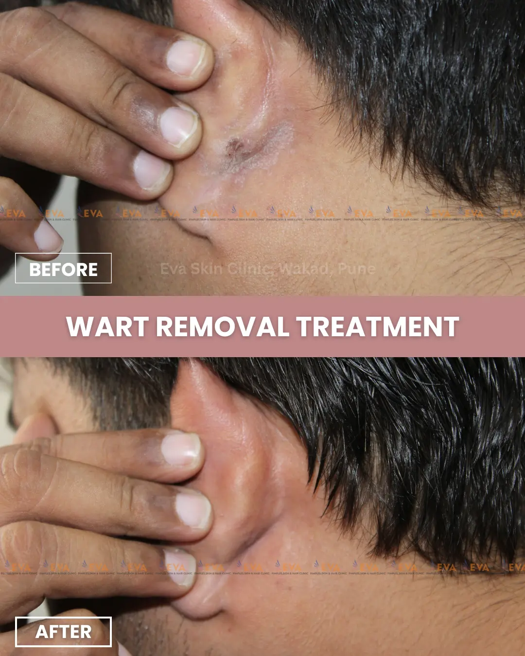 Wart-removal-before-after-results