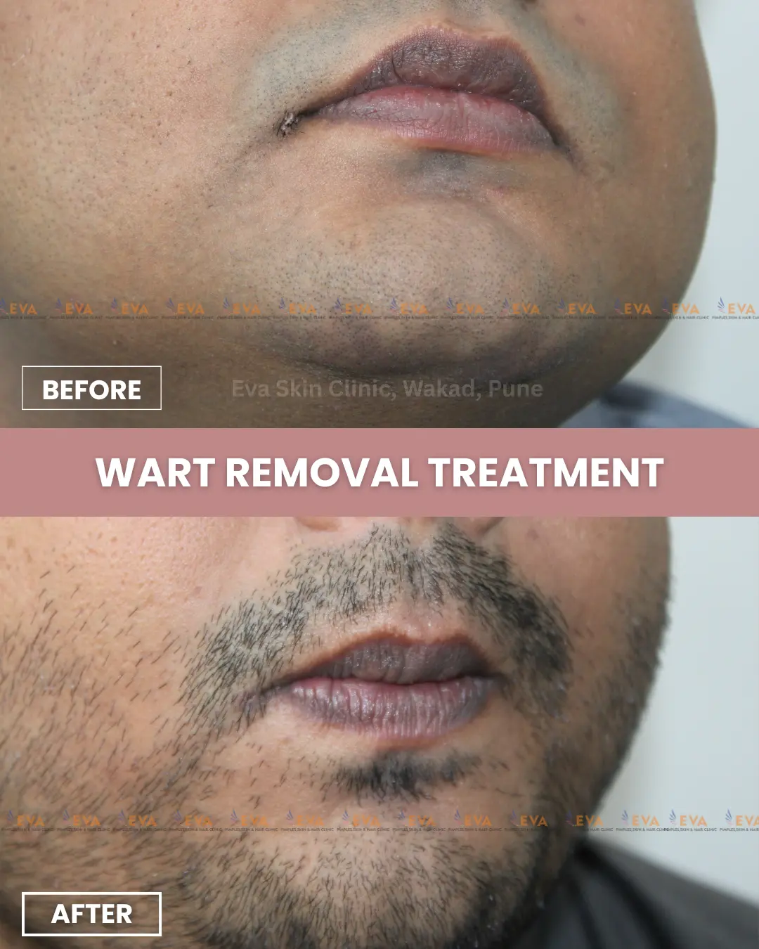 Wart-removal-results