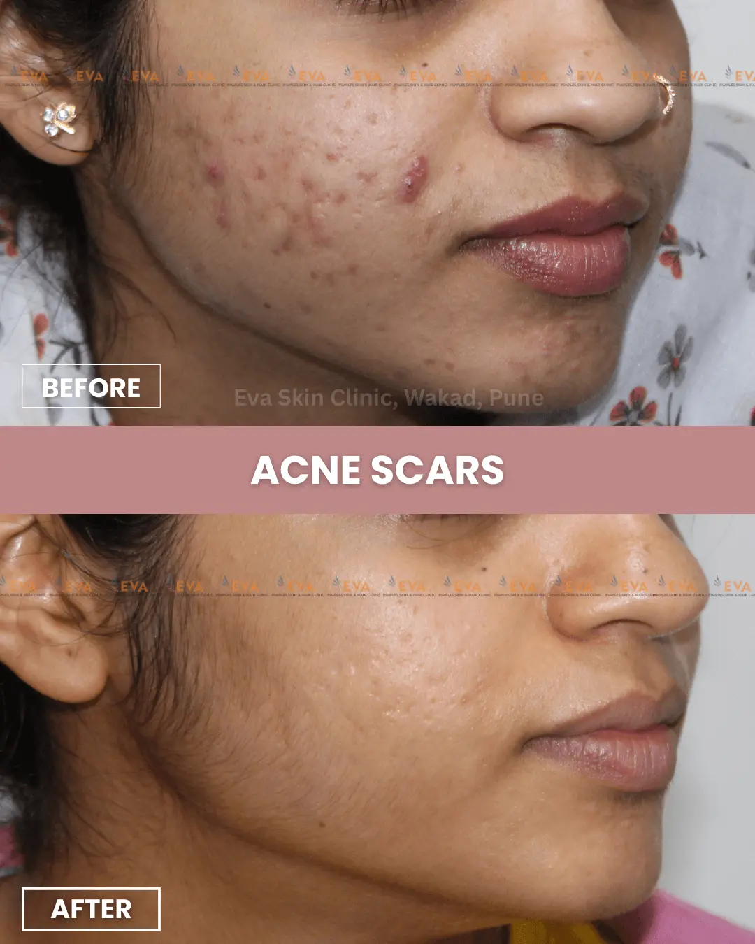 acne-before-after-eva-skin-clinic