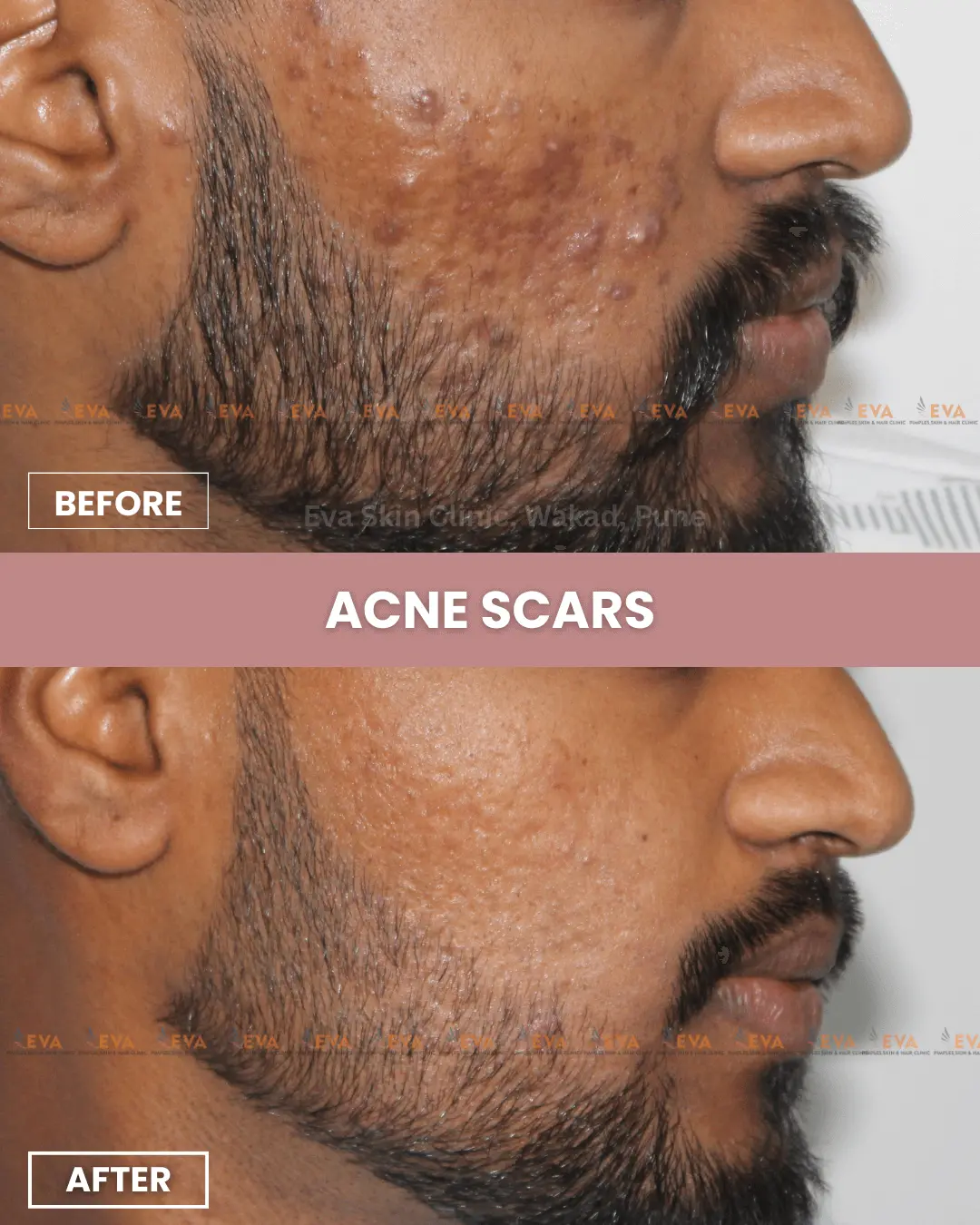 acne-before-after-treatment