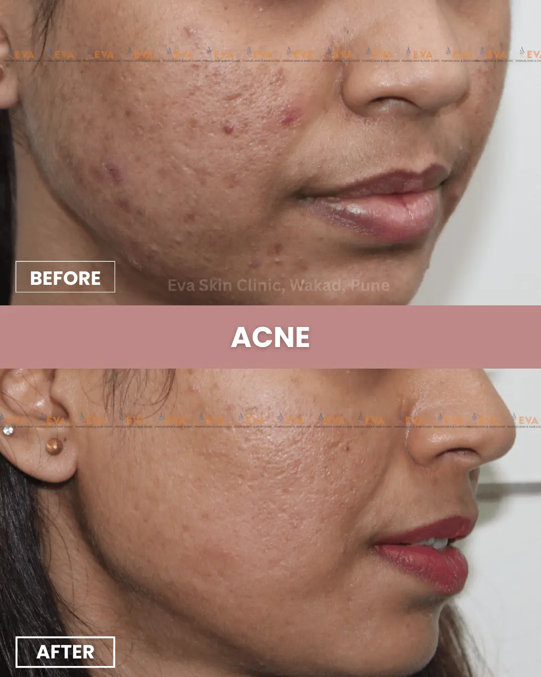 acne-before-after-wakad-pune