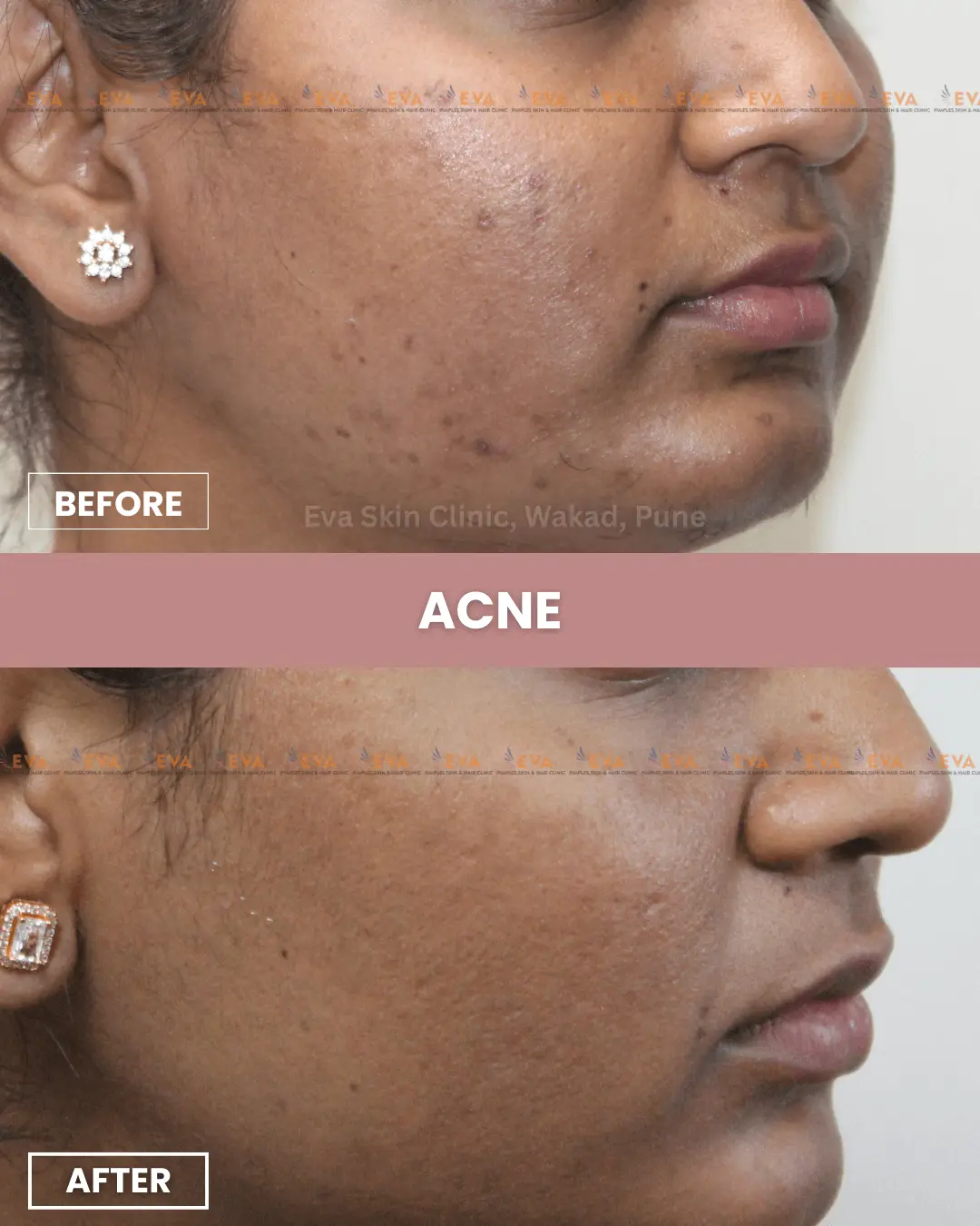 acne-best-results