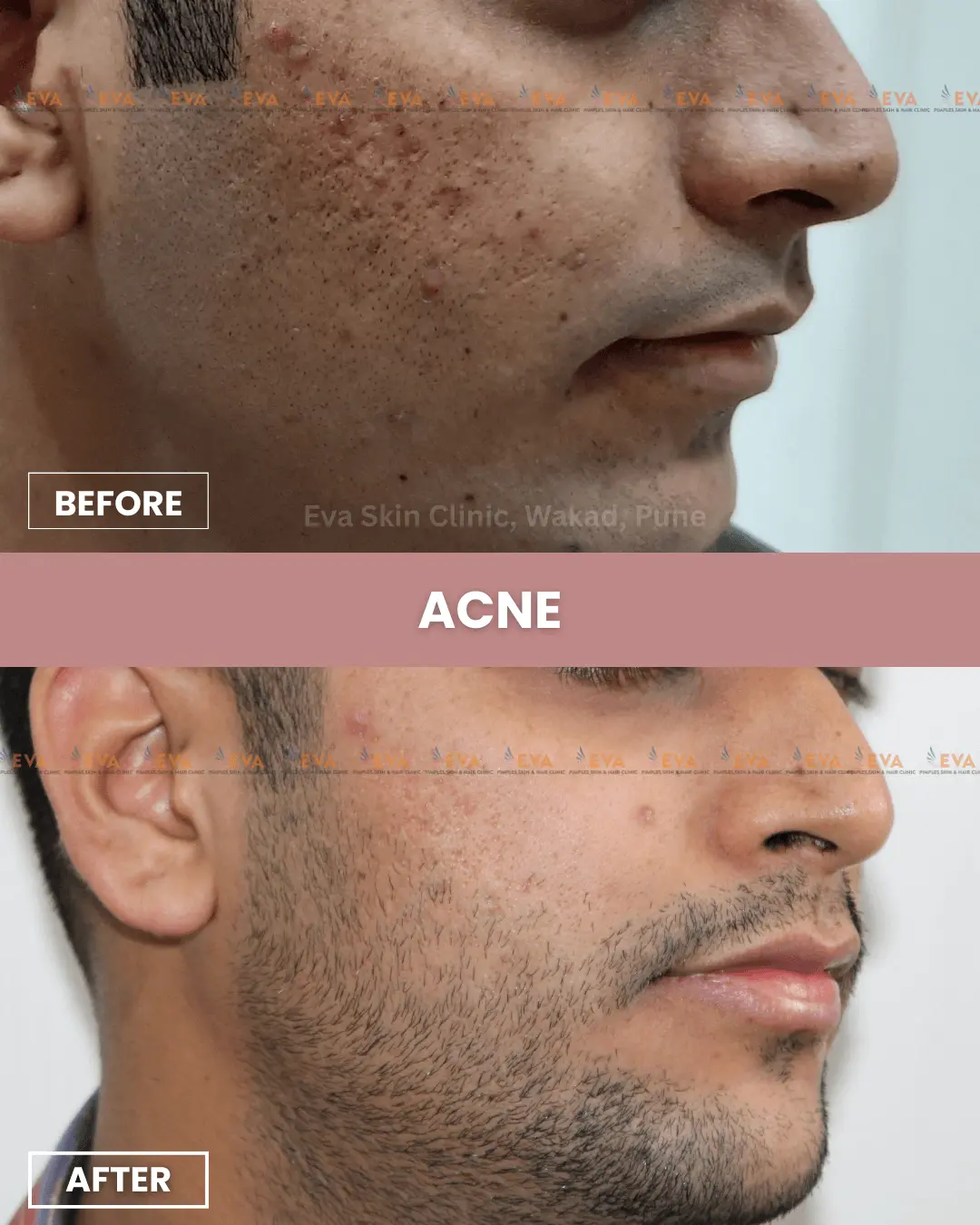 acne-pimple-results