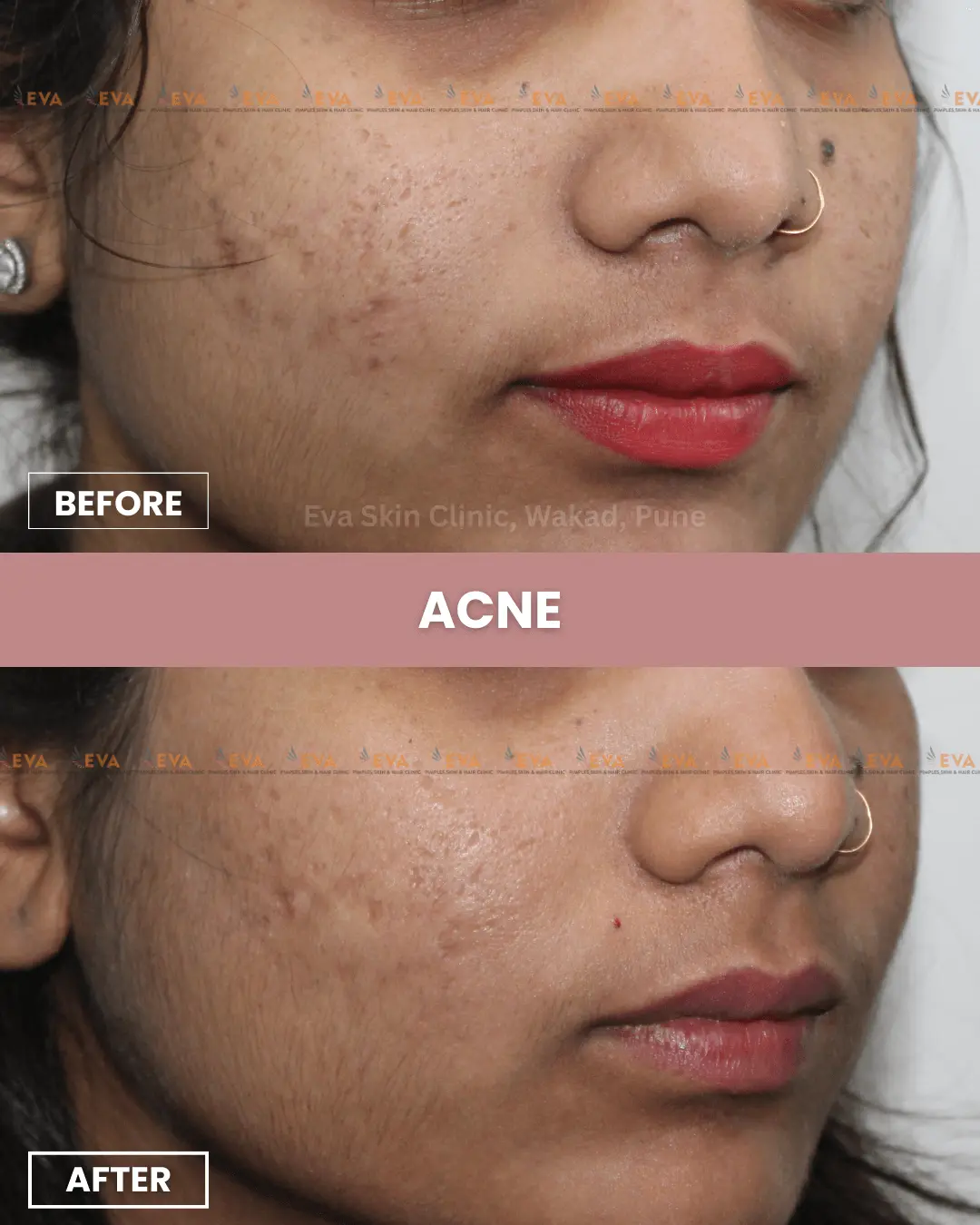 acne-pimple-treatment-in-pune