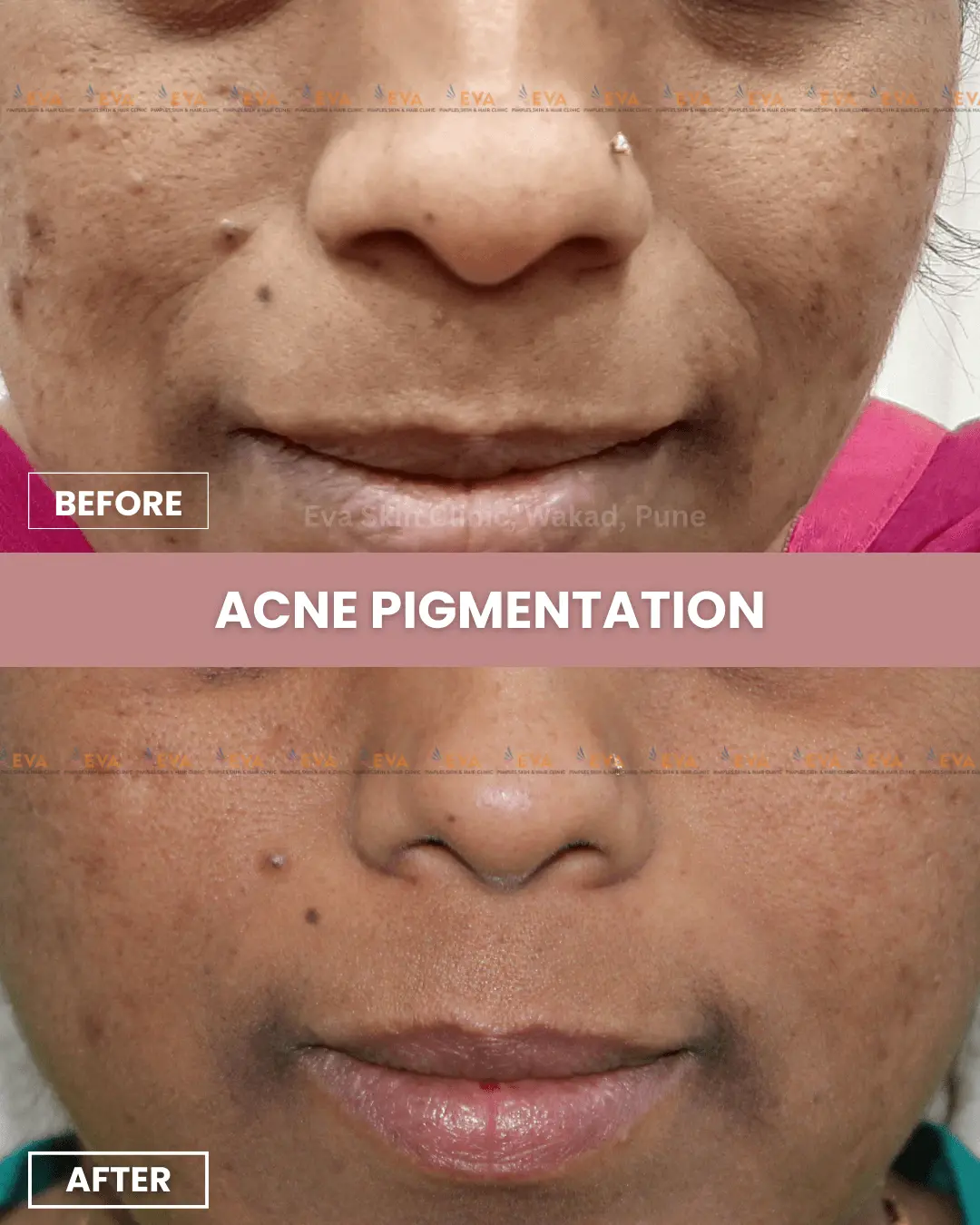 acne-pimple-treatment-results
