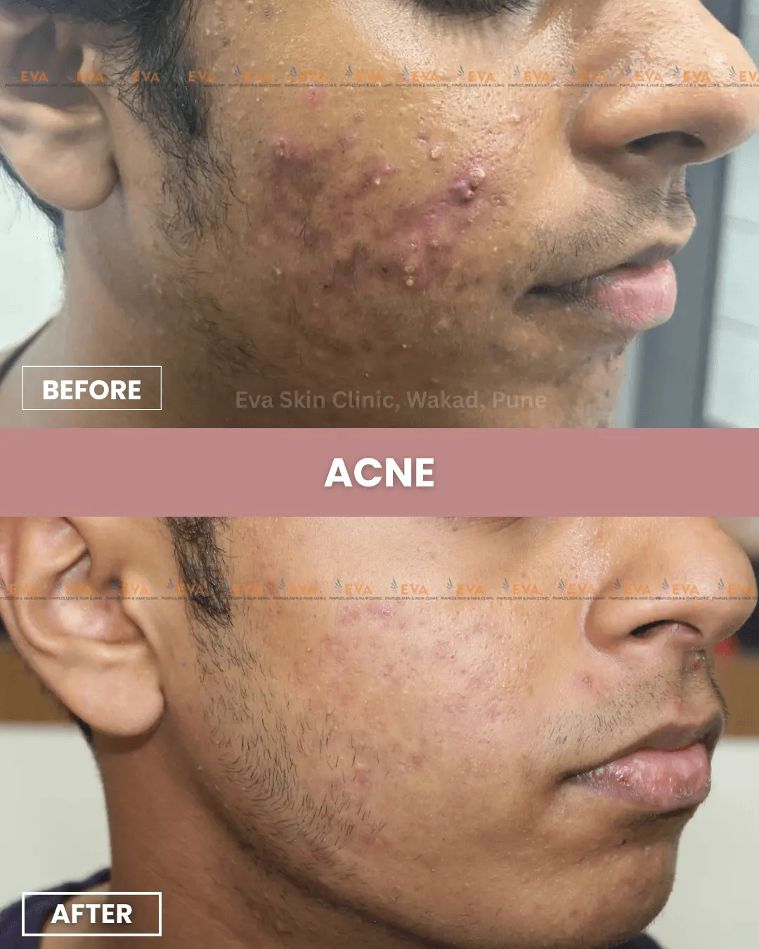 acne-results-by-dermatologist