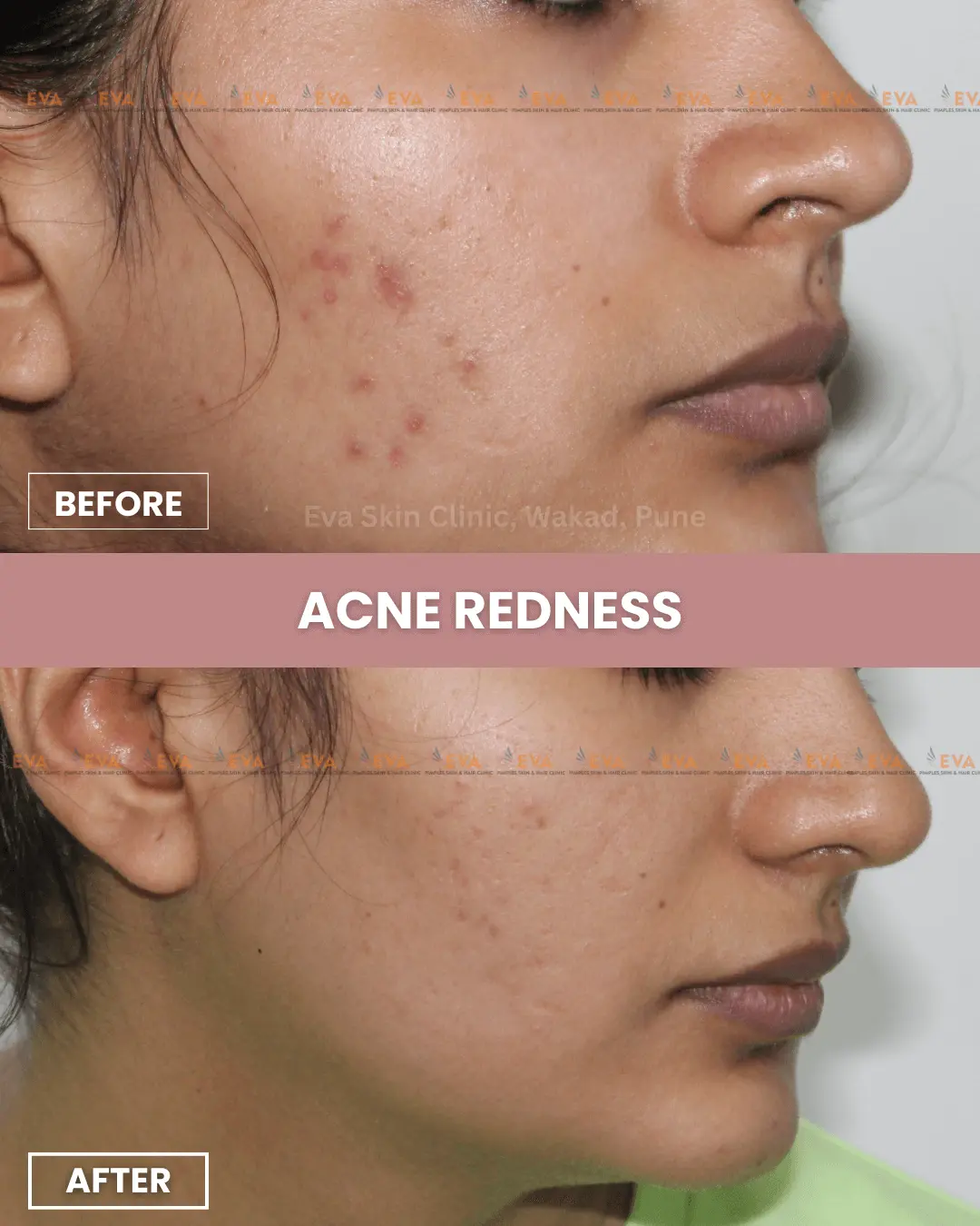 acne-results-eva-skin-clinic