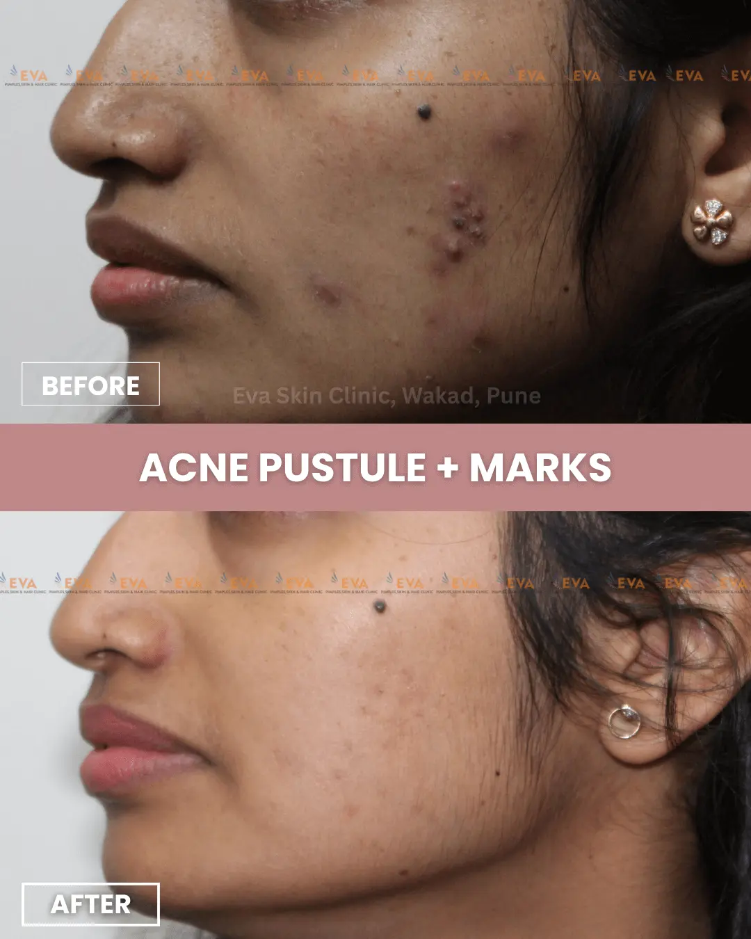 acne-results-glowing-skin