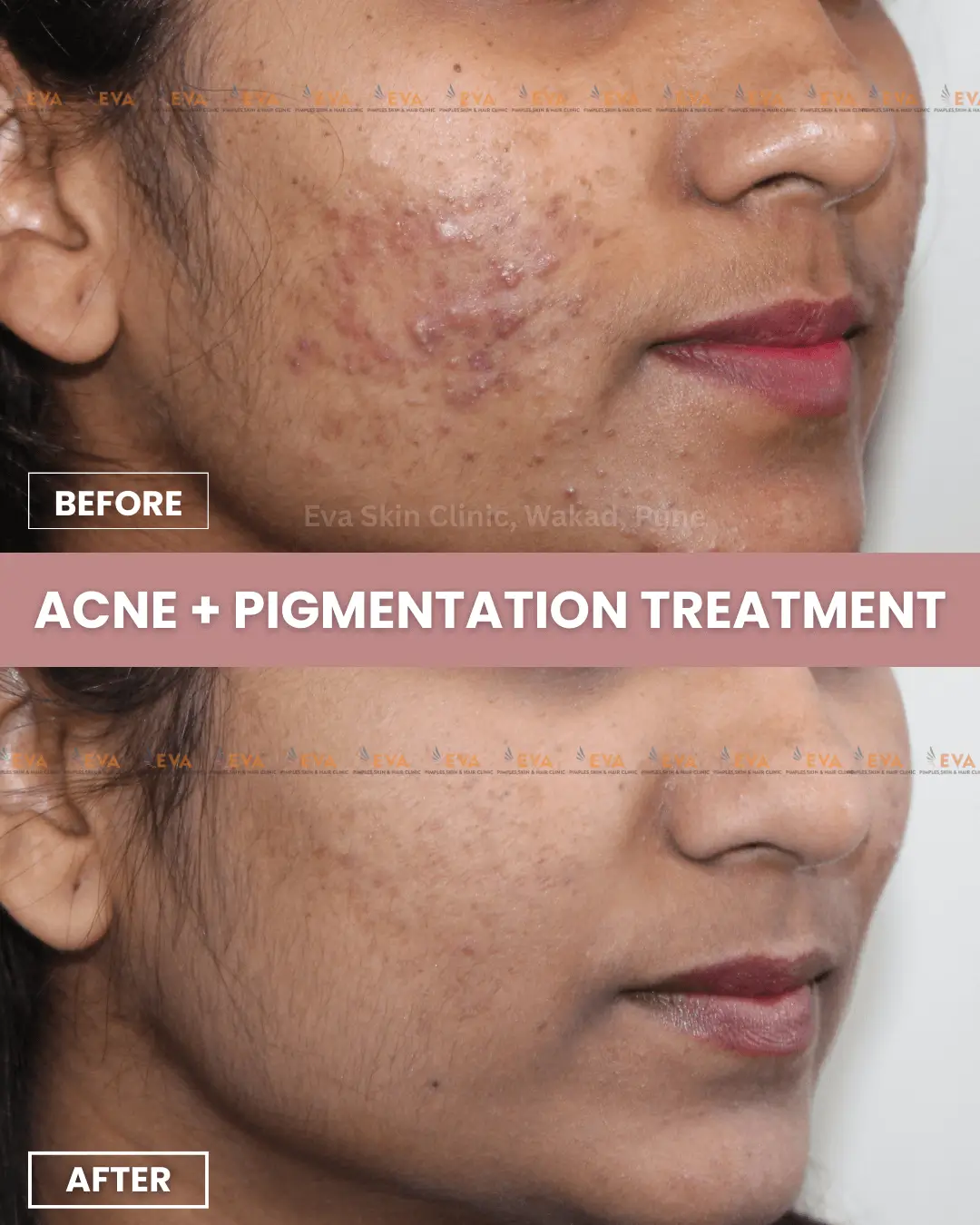 acne-results-in-pune