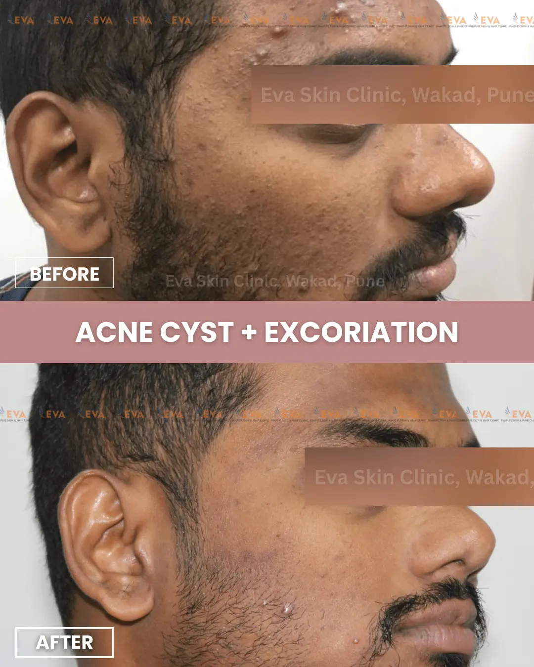 acne-results