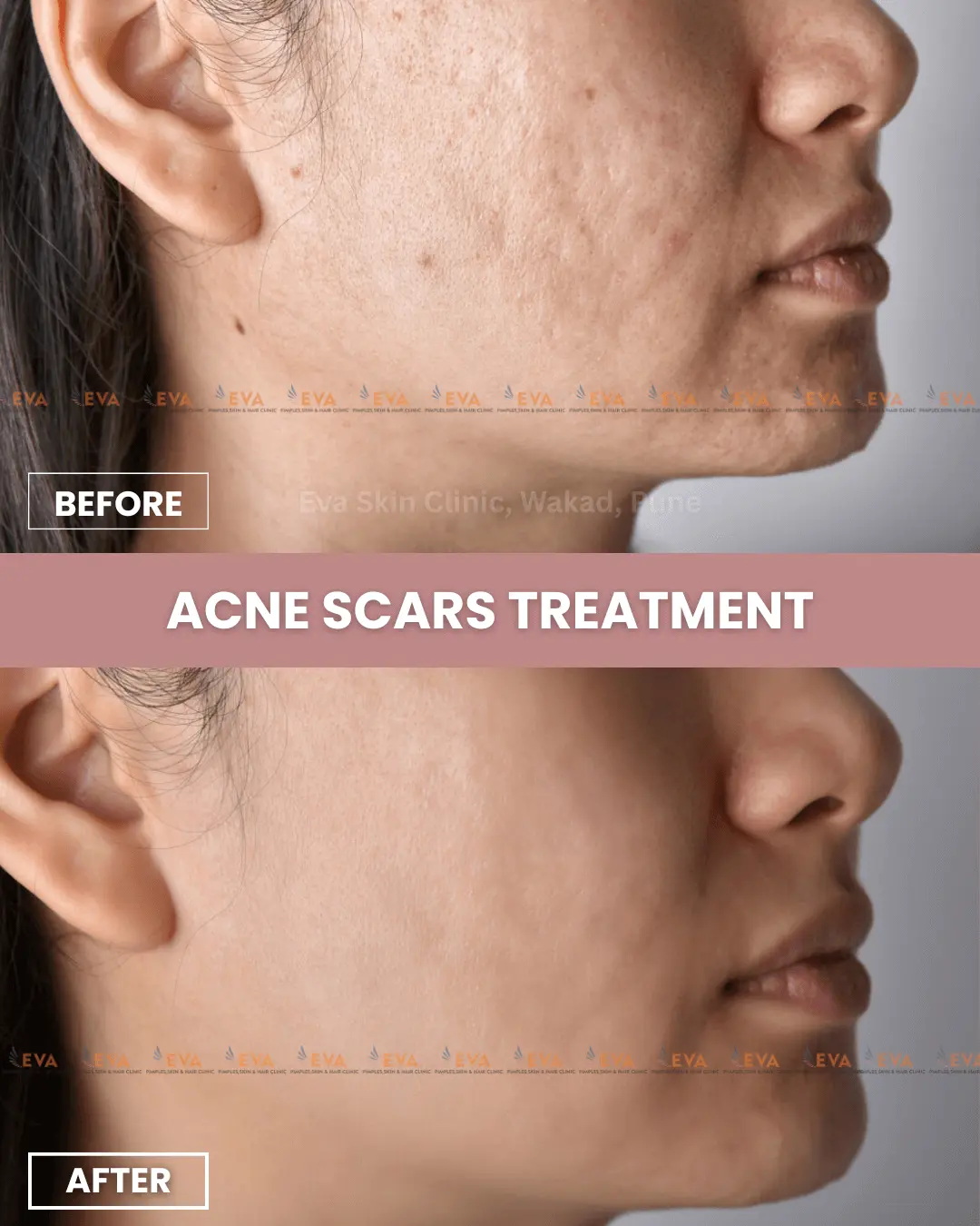 acne-scars-results