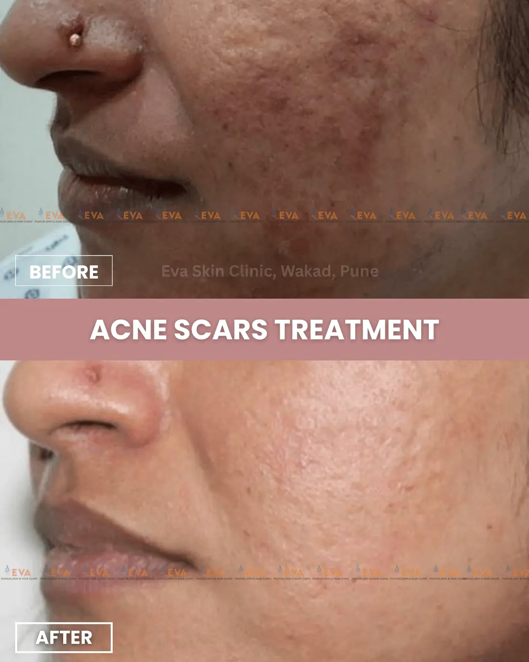 acne-scars-results-in-pune