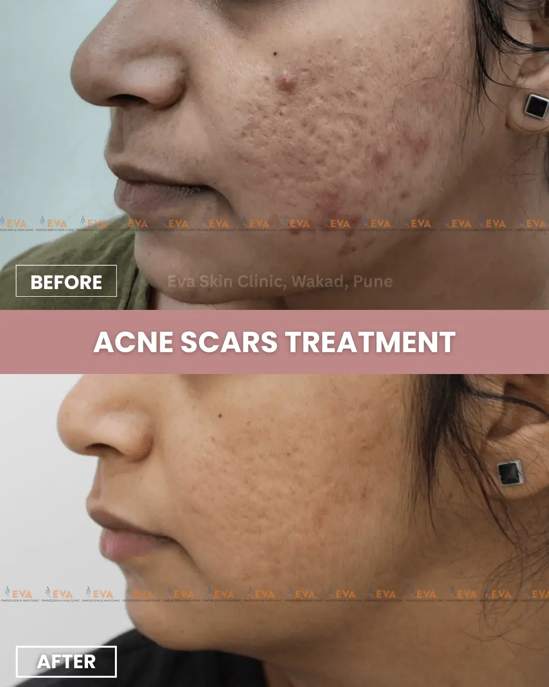 acne-scars-results-pune