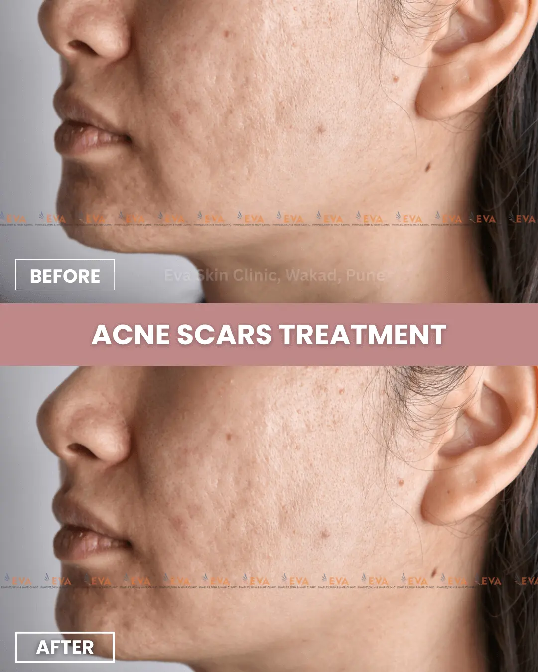 acne-scars-results