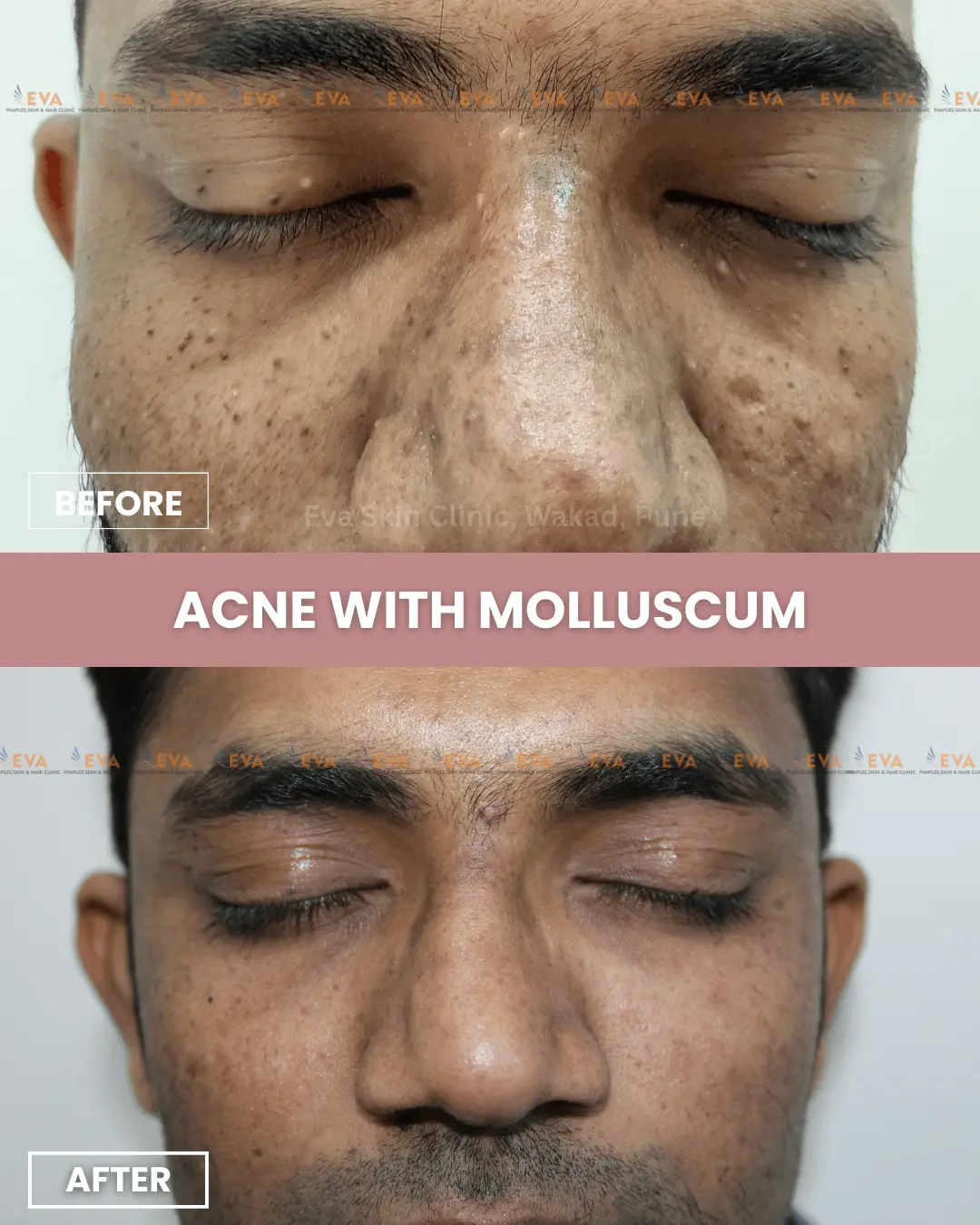 acne-treamtnet-eva-skin-clinic-wakad-pune
