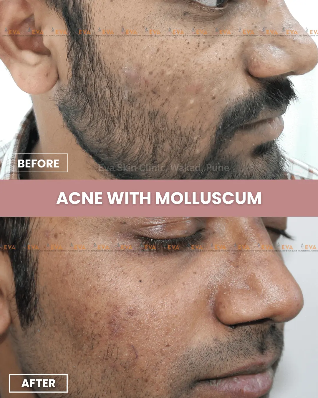 acne-treatment-eva-skin-clinic