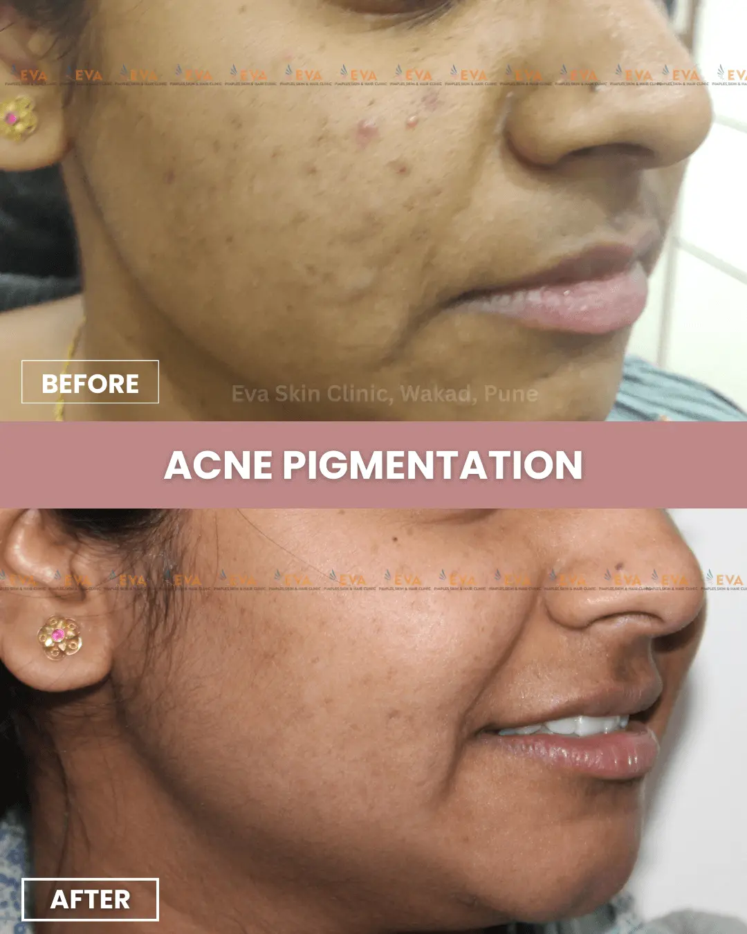 acne-treatment-in-pune