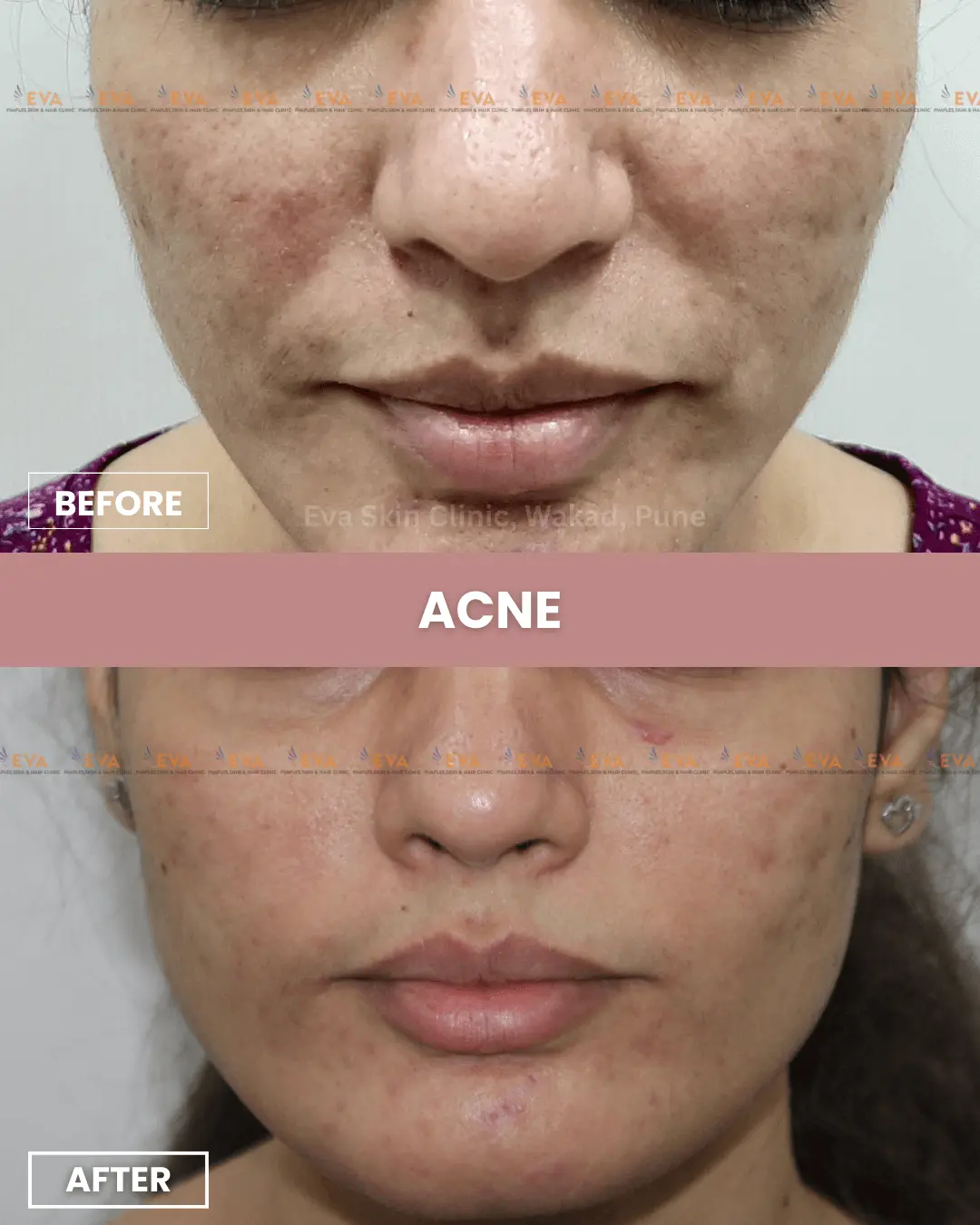 acne-treatment-in-wakad