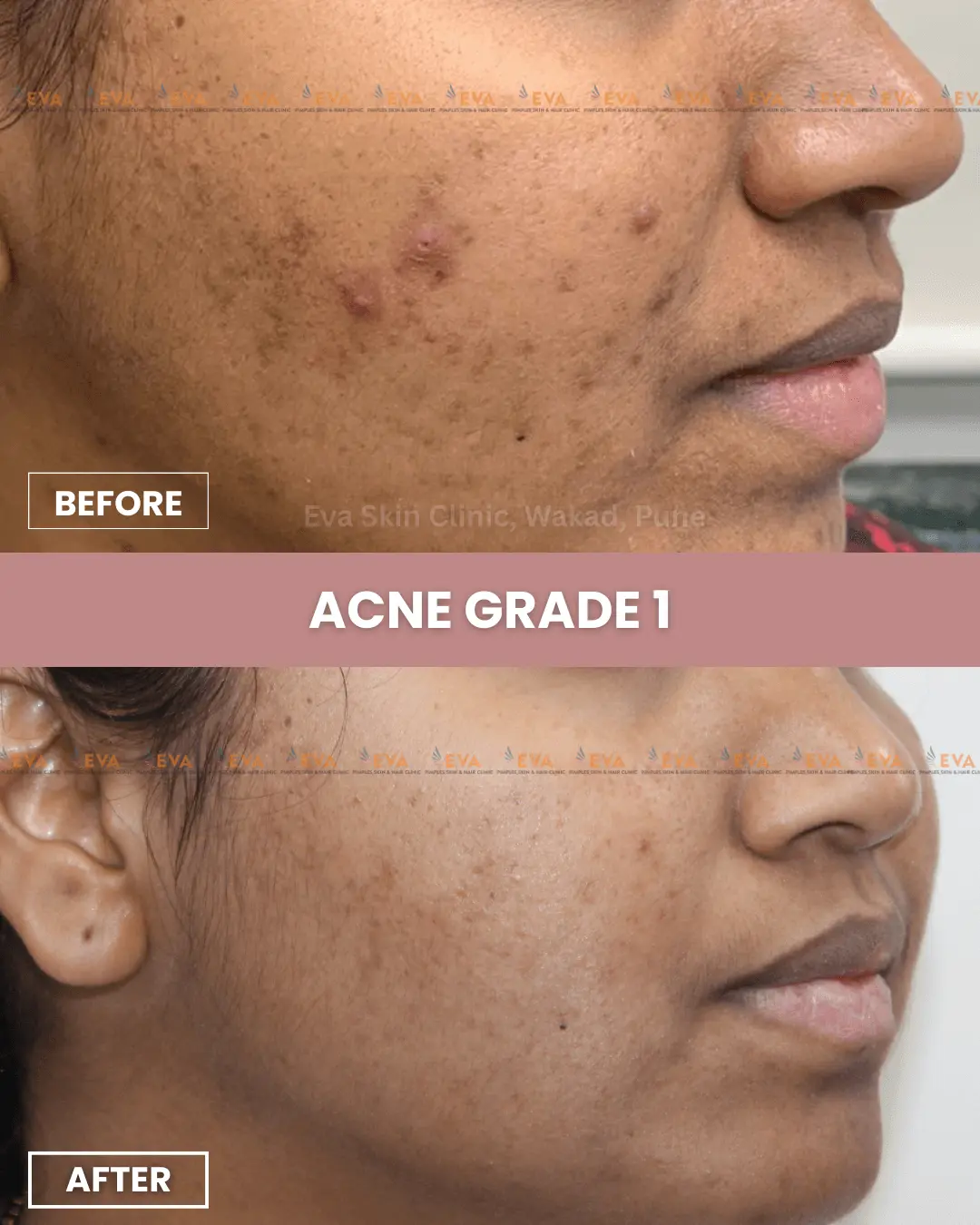 acne-treatment-results