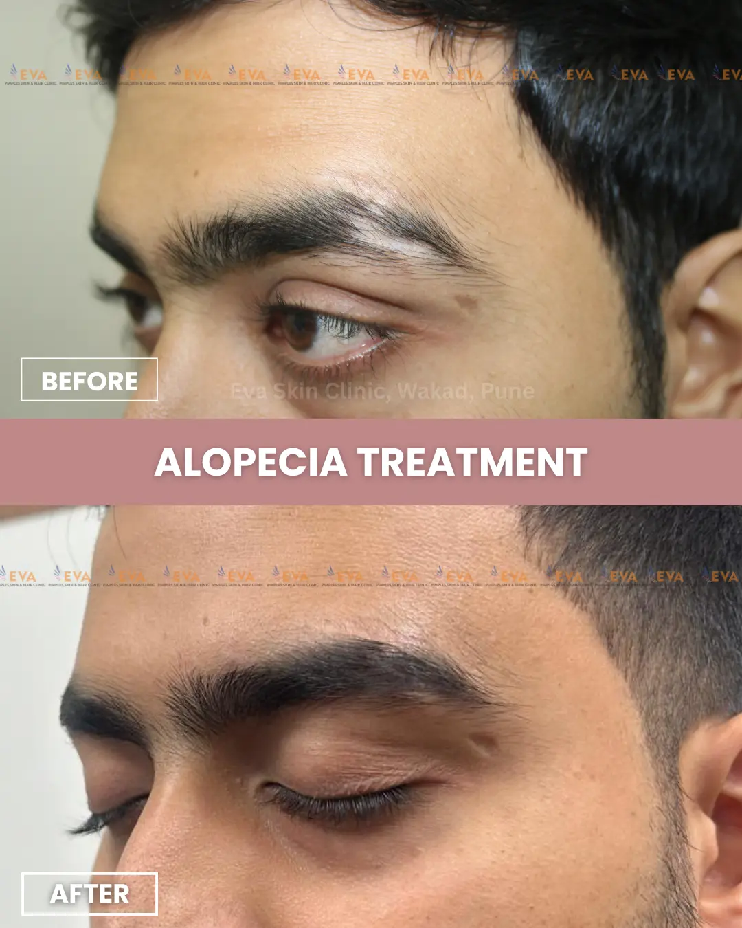 alopecia treatment