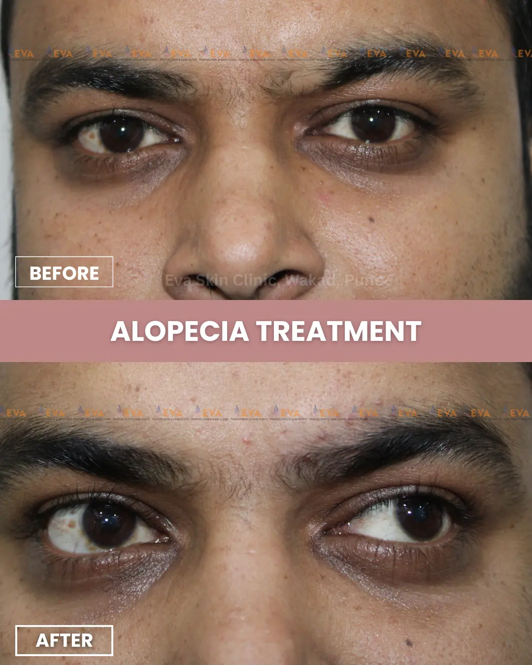 alopecia-results-in-pune