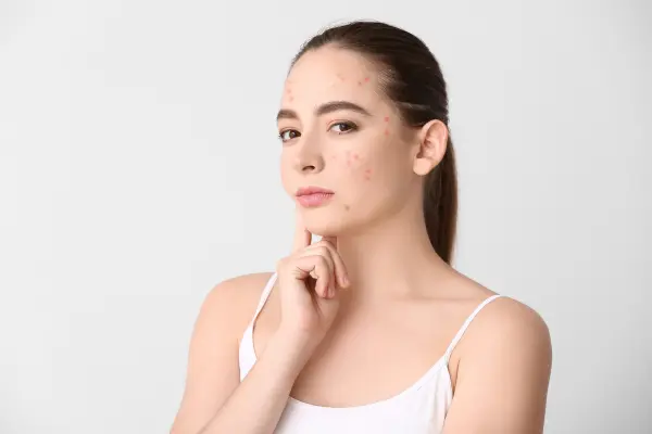 anti-acne-medication