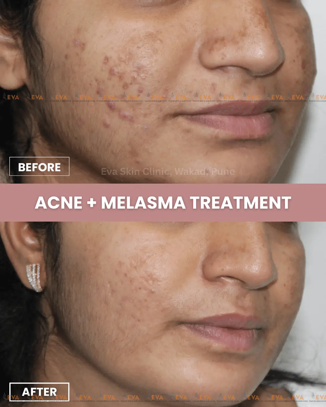 best-acne-results-in-pune