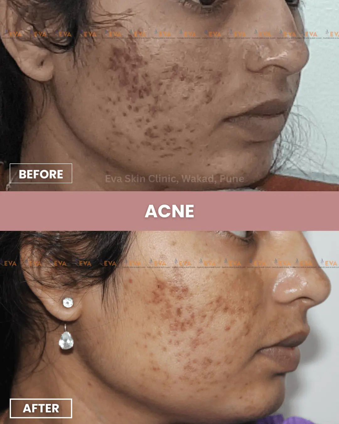 best-acne-results-in-wakad